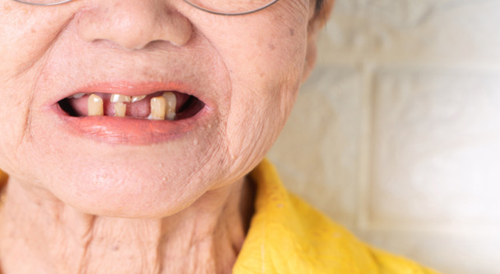 ฟันของผู้สูงอายุที่มีอาการเหงือกลร่น ฟีนล้ม ฟันหลอ